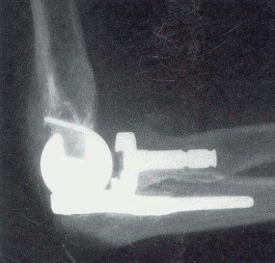 DePuy Pritchard Total Elbow Prosthesis (Implant 104)